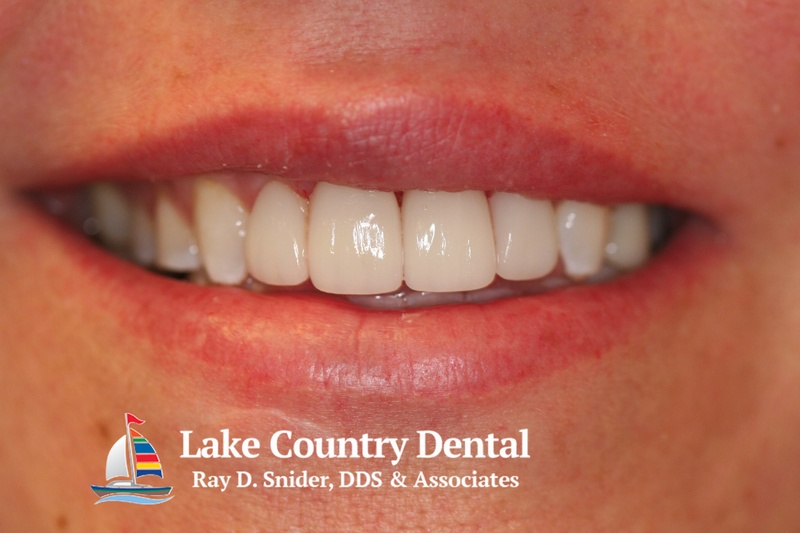 Our Patient Gallery Lake Country Dental