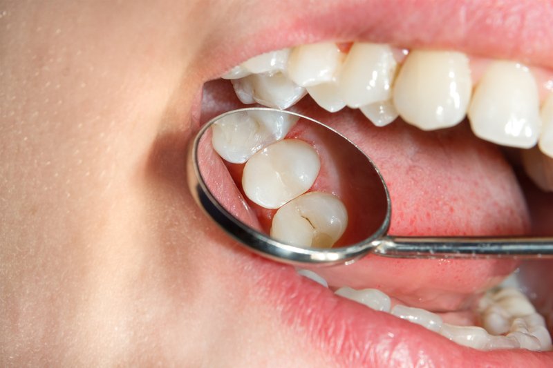 closeup of teeth being examined with mirror
