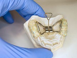 palatal expander on a tooth model