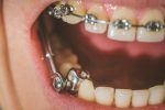 Dental,Appliance,For,Deep,Bite