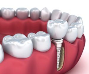 model of dental implants